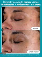 2%-BHA-Liquid-Exfoliant-Before-and-After