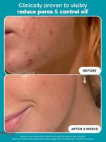 2%-BHA-Liquid-Exfoliant-Before-and-After3